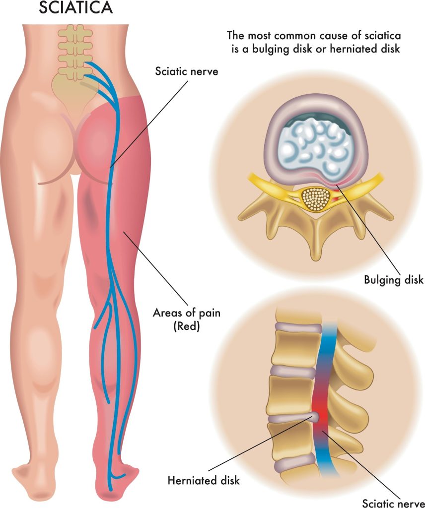 Illustration of sciatica caused by a herniated disc. A diagram of a person's lower body shows the sciatic nerve path and the areas of pain it affects. Close-ups of the spine highlight how a bulging or herniated disc can compress the nerve root, causing pain.